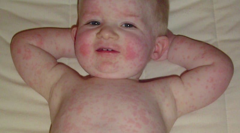 Otroška bolezen - peta bolezen