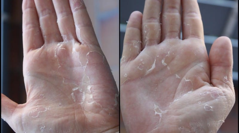 Otroške bolezni - škrlatinka