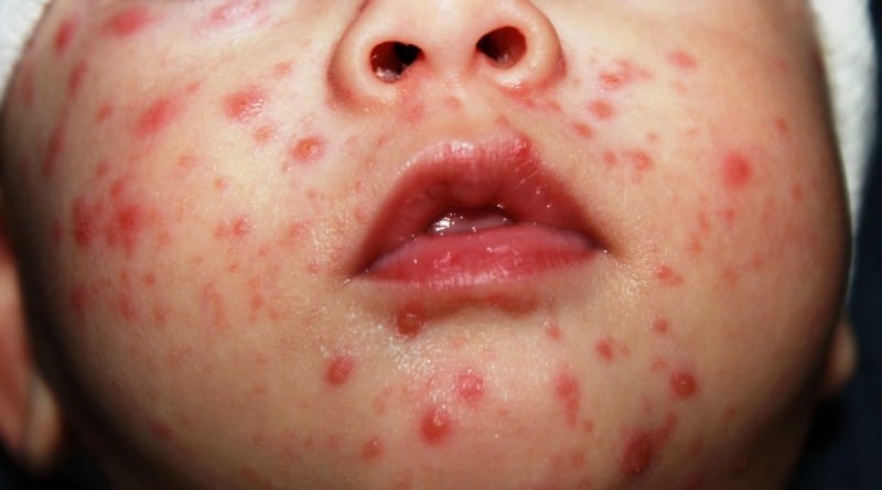 Norice - zdravljenje na naraven način