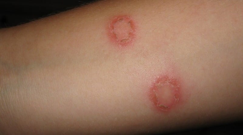 Mikrosporija ali mačja bolezen