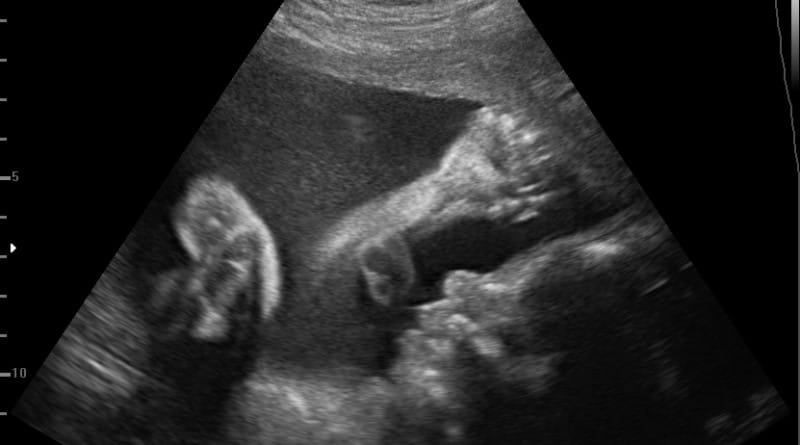 To je najin sin v 3D/ 4D tehniki