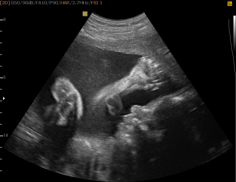 To je najin sin v 3D/ 4D tehniki