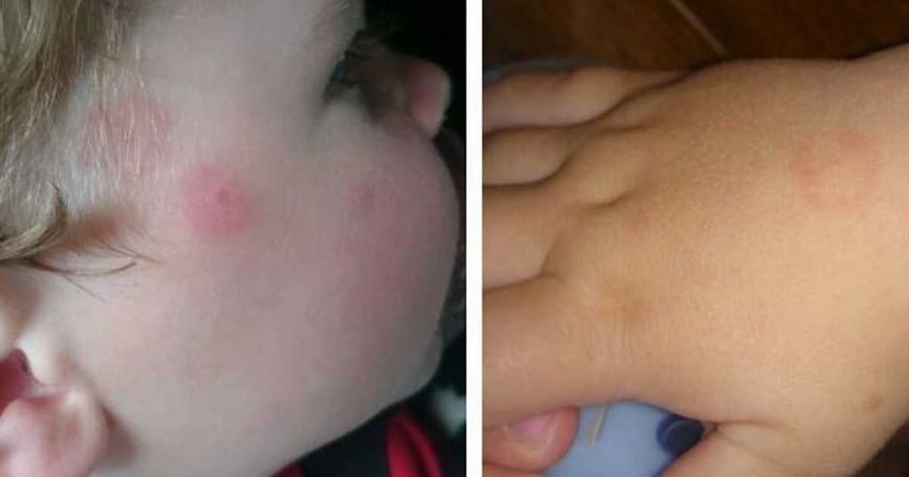 Borelioza ali lymska bolezen - nevarnost preži tudi na otroke