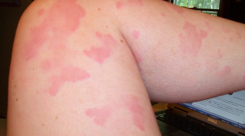 Koprivnica ali urtikarija - zmote in napačna prepričanja