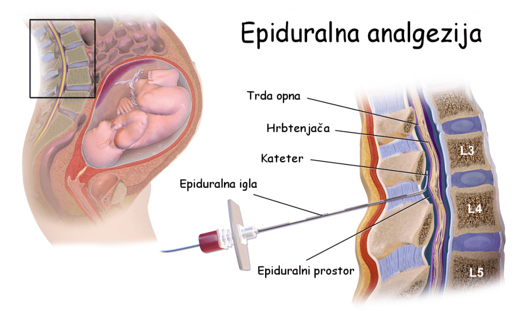 Uporaba epiduralne analgezije med porodom - koristi in nevarnosti