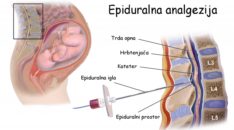 Uporaba epiduralne analgezije med porodom - koristi in nevarnosti