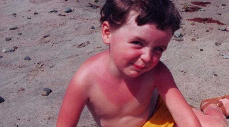 Sončne opekline pri otrocih - naravni pripravki za blaženje