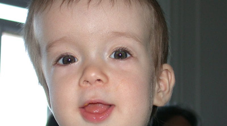 Kraniosinostoza metopične suture s trigonocefalijo