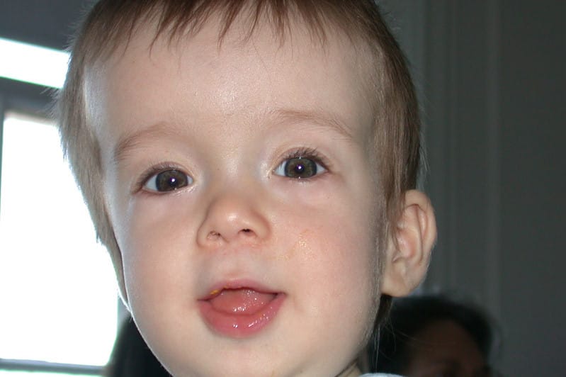 Kraniosinostoza metopične suture s trigonocefalijo