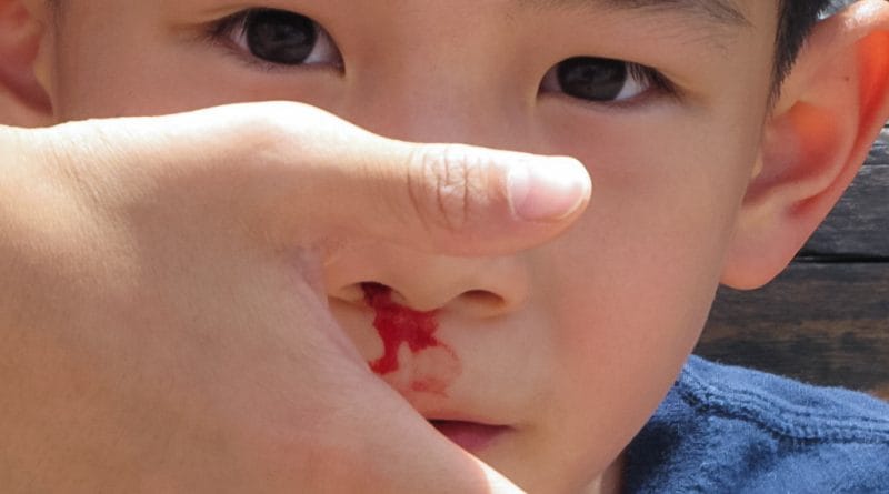 Krvavitev iz nosu pri otrocih