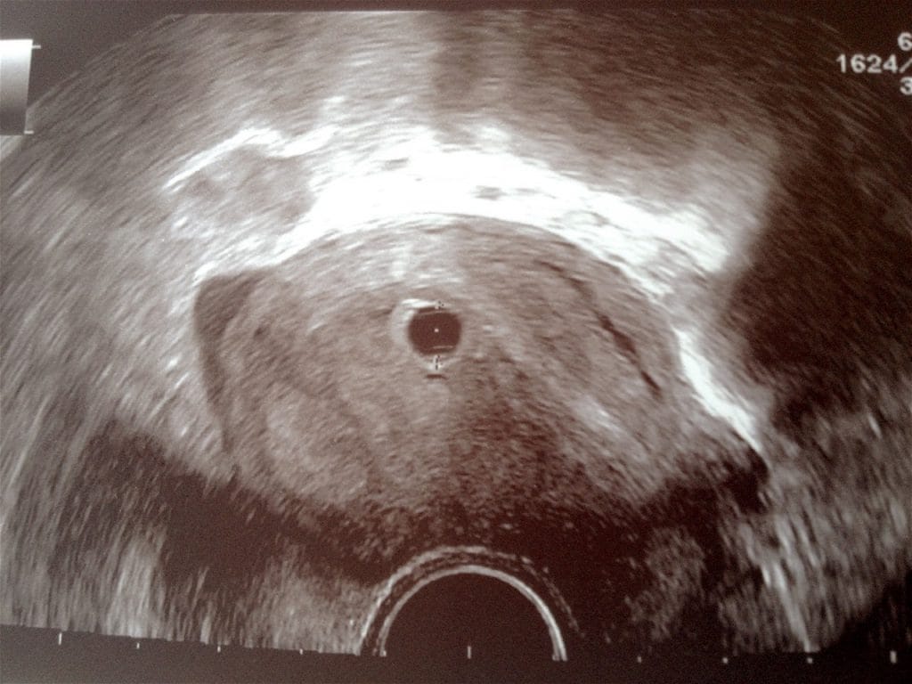 Nosečniški dnevnik: 7. teden - ultrazvok