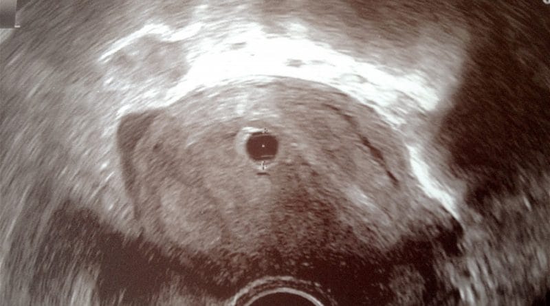 Nosečniški dnevnik: 7. teden - ultrazvok