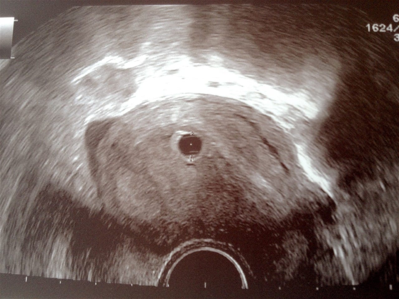 Nosečniški dnevnik: 7. teden - ultrazvok