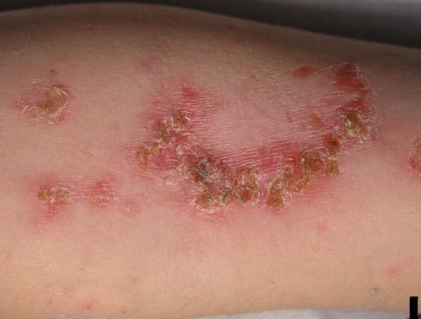 Impetigo - najpogostejša okužba kože pri otrocih