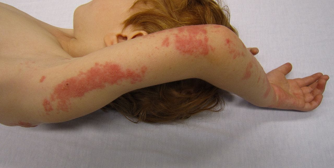 Herpes zoster ali pasovec - simptomi in zdravljenje