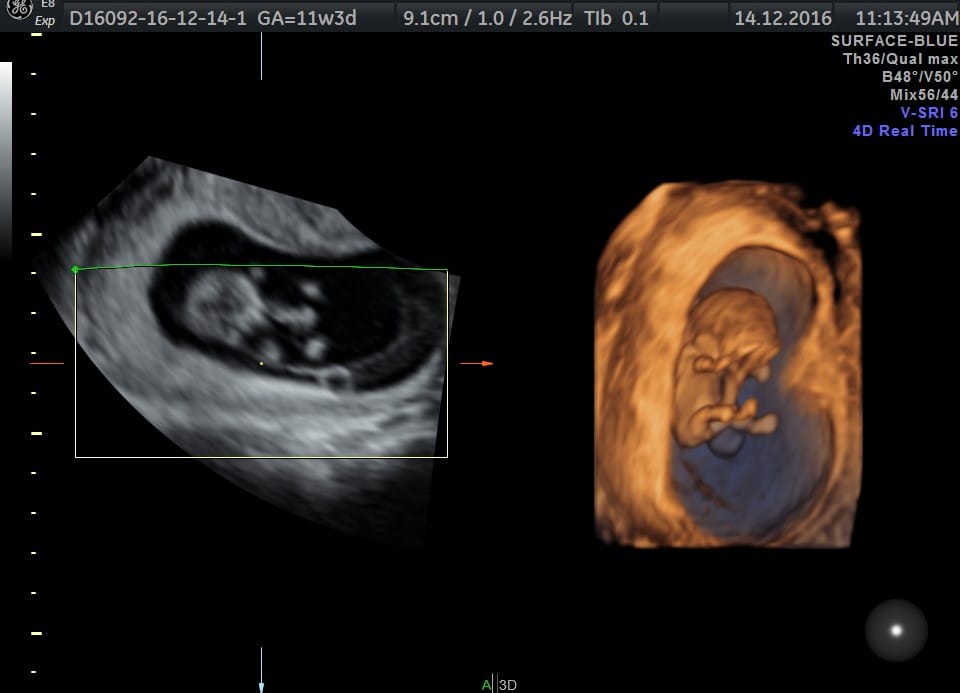 Nosečniški dnevnik 2: Pregled nuhalne svetline