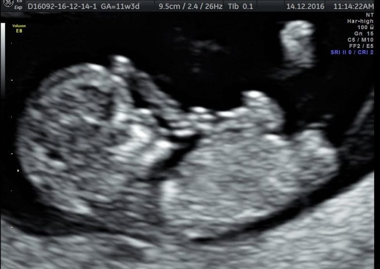 Nosečniški dnevnik 2: Pregled nuhalne svetline