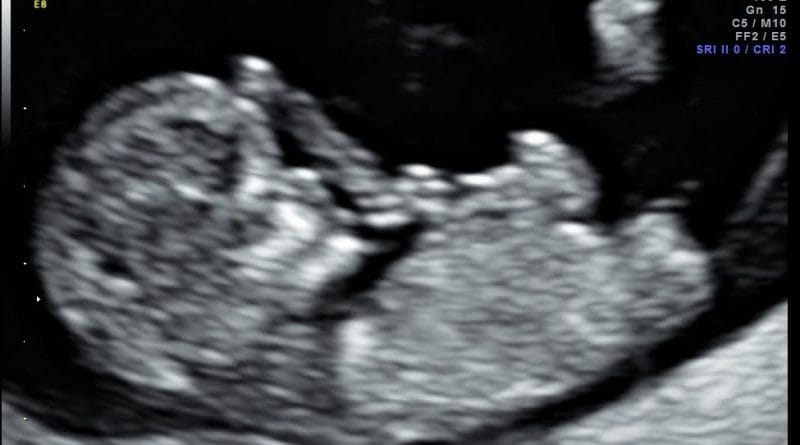 Nosečniški dnevnik 2: Pregled nuhalne svetline