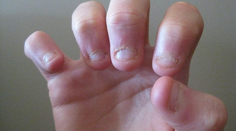 Grizenje nohtov - pomagajte otroku, da se ga odvadi