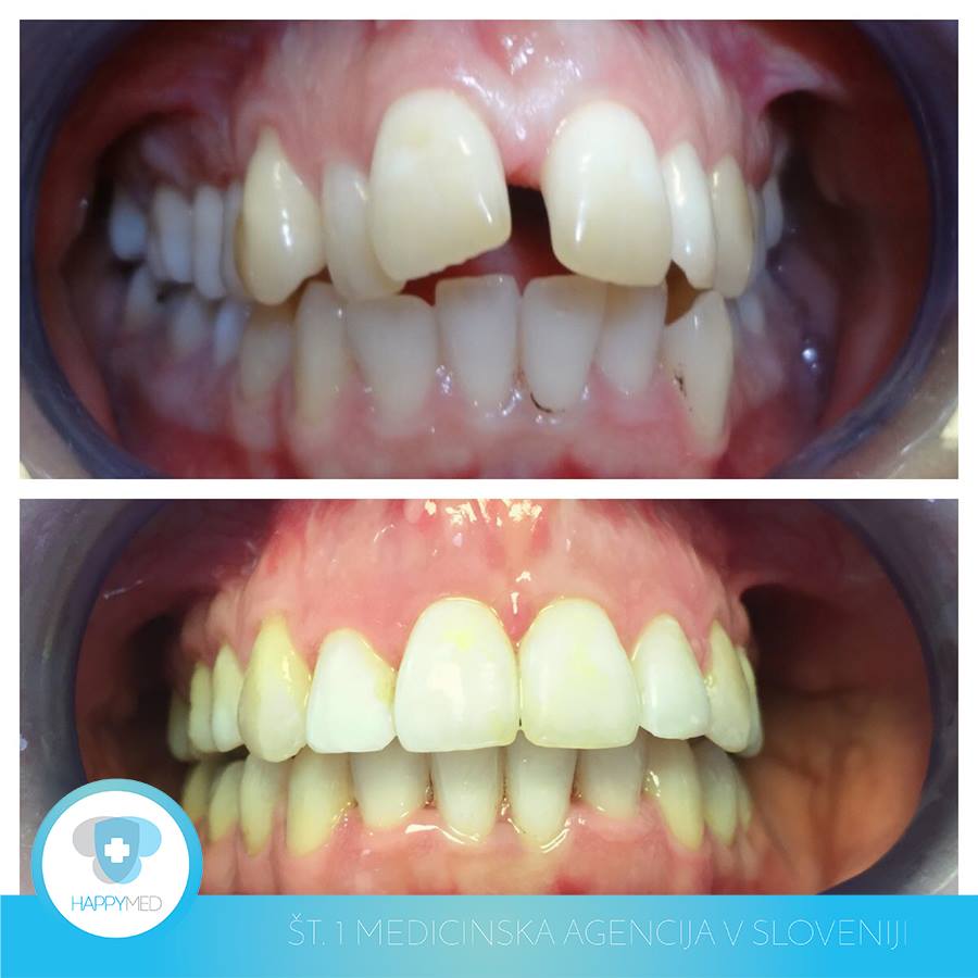 Zobni aparat na napotnico brez čakalne dobe