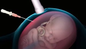 Amniocenteza ali NIFTY test?