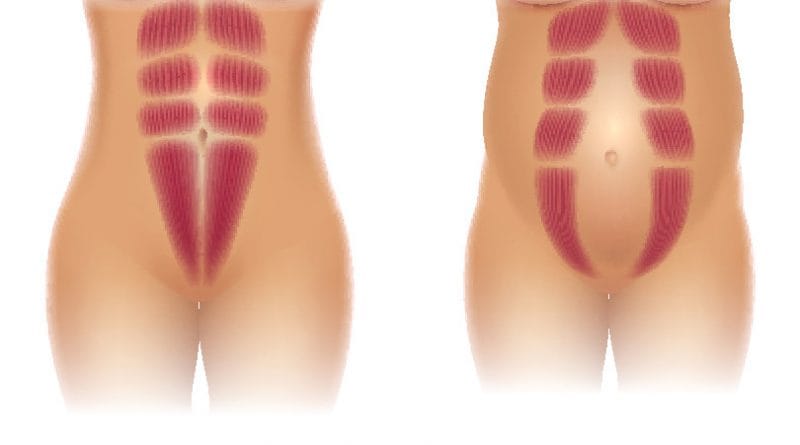 Diastaza rektusov - kirurško zdravljenje