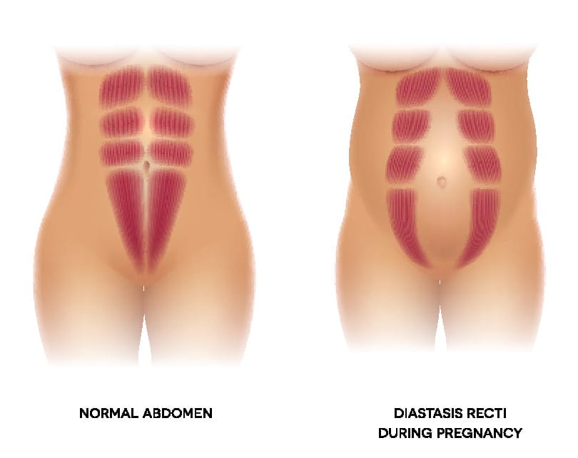 Diastaza rektusov - kirurško zdravljenje