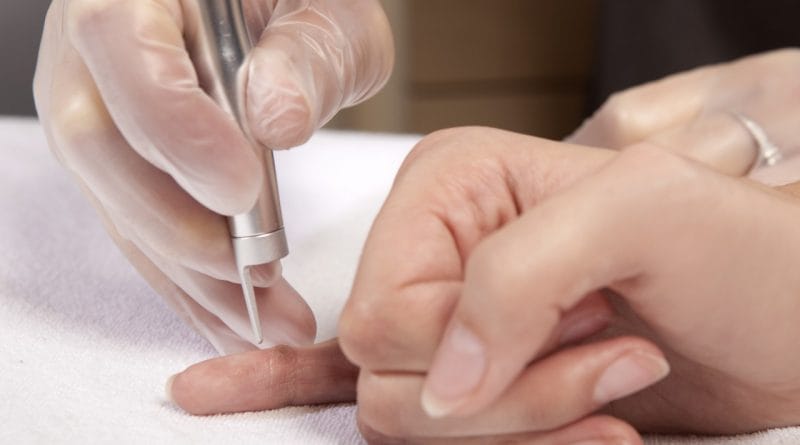 Navadne bradavice - lasersko odstranjevanje